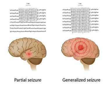 Парциальная епілепсія і генералізовані напади, симптоми і лікування