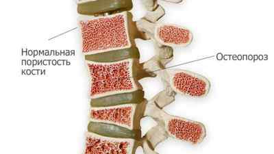Патологічний компресійний перелом хребта: причини і лікування перелому хребта з метастазами, МКБ 10 | Ревматолог