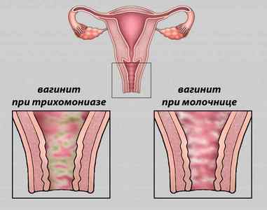 Підгострий вагініт: причини, симптоми, лікування