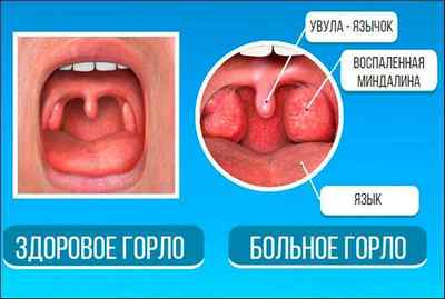 Піднебінний язичок в горлі збільшився: причини, лікування