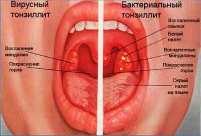 Піднебінний язичок в горлі збільшився: причини, лікування
