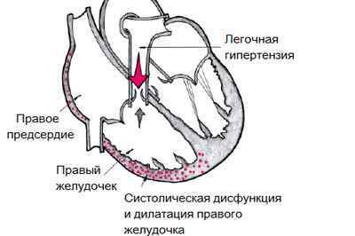 Підшкірна емфізема грудної клітини та шиї: що це таке, симптоми, лікування