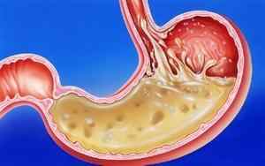 Підвищена кислотність шлунка: симптоми і лікування, дієта, діагностика