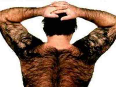 Підвищена волосатість у чоловіків (гіпертрихоз): причини і як позбутися