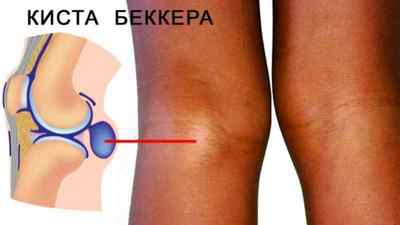 Печіння в колінному суглобі: причини і лікування, коліно гаряче і пекучий біль, що це може бути, причини печіння під коліном | Ревматолог