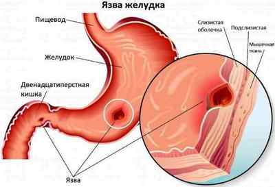 Пенетрація виразки шлунка: симптоми, методики хірургії, дієта після операції