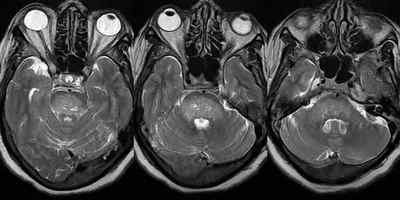 Передня і задня ішемічна нейропатія зорового нерва