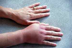 Перелом кисті руки - симптоми і лікування