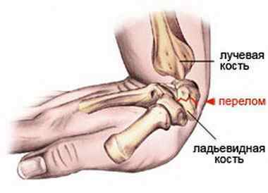 Перелом кисті руки - симптоми і лікування