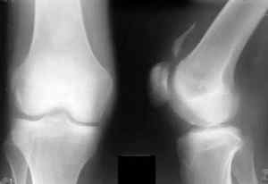 Перелом колінного суглоба - причини, симптоми і лікування