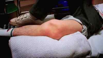 Перелом колінного суглоба: розробка колінного суглоба після зняття гіпсу, вправи в домашніх умовах, симптоми | Ревматолог