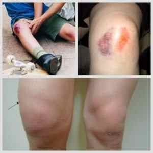 Перелом колінного суглоба: розробка колінного суглоба після зняття гіпсу, вправи в домашніх умовах, симптоми | Ревматолог