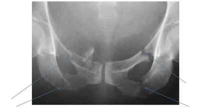 Перелом лонної кістки таза: лікування та наслідки перелому лобкової кістки, реабілітація та термін лікування, код за МКХ 10 | Ревматолог