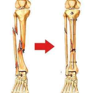 Перелом малої і великої гомілкової кістки зі зміщенням та без: скільки ходити в гіпсі і як розробляти ногу, реабілітація | Ревматолог