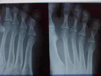 Перелом мізинця на нозі - симптоми і лікування