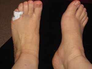 Перелом мізинця на нозі: симптоми і як лікувати перелом зі зміщенням, фото | Ревматолог