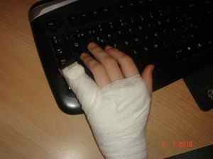 Перелом мізинця на руці - симптоми і лікування