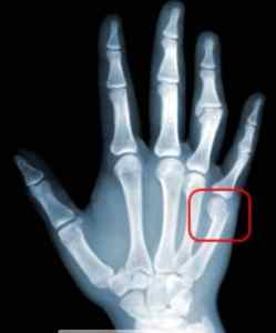 Перелом мізинця на руці - симптоми і лікування