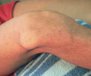 Перелом надколінника: чи можна ходити і терміни лікування перелому колінної чашечки, перелом зі зміщенням і без, реабілітація | Ревматолог
