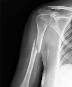 Перелом плечової кістки - симптоми і лікування