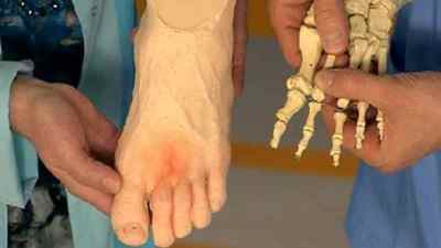 Перелом плеснової кістки стопи: скільки заживає, симптоми і лікування | Ревматолог