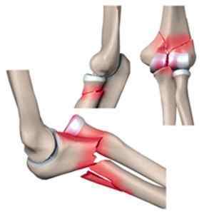 Перелом променевої кістки руки зі зміщенням в типовому місці: реабілітація, ЛФК та як розробляти руку гімнастикою, скільки носити гіпс | Ревматолог