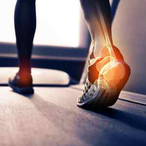 Перелом пяткової кістки зі зміщенням: скільки заживає і коли можна наступати на ногу, реабілітація і лікування, як розробляти | Ревматолог