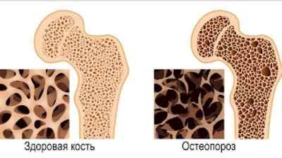 Перелом ребра: симптоми і лікування, як спати, скільки заживає перелом або тріщина грудної клітини, температура при ударі | Ревматолог