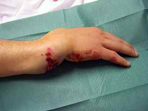 Перелом руки зі зміщенням: причини, симптоми, діагностика та лікування