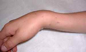 Перелом руки зі зміщенням: причини, симптоми, діагностика та лікування
