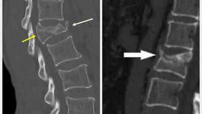 Перелом шийного хребця: наслідки, симптоми компресійного перелому хребта, перелом остистого відростка | Ревматолог