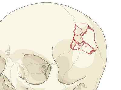 Перелом склепіння черепа: причини, симптоми, лікування і наслідки