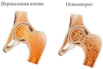 Перелом стегна (стегнової кістки): які суглоби підлягають фіксації і реабілітація після операції, наслідки у літніх людей | Ревматолог