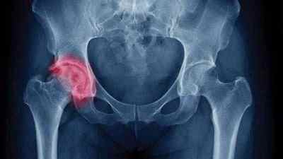Перелом тазостегнового суглоба зі зміщенням: лікування в літньому віці, бандаж, ортез і корсет | Ревматолог