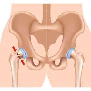 Перелом тазостегнового суглоба зі зміщенням: лікування в літньому віці, бандаж, ортез і корсет | Ревматолог
