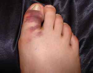 Перелом великого пальця ноги - симптоми і лікування