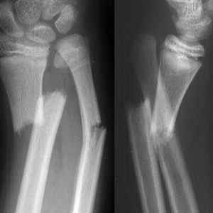 Переломи кісток гомілки: як розробляти ногу і перша допомога, реабілітація та відновлення, симптоми і накладення шини | Ревматолог