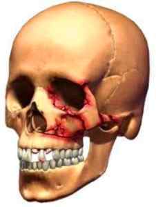 Переломи кісток лицьового черепа - види, симптоми і лікування