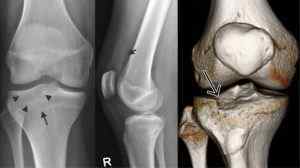 Переломи виростків великогомілкової кістки: терміни лікування і реабілітація, Імпресійна і внутрішньосуглобової перелом | Ревматолог