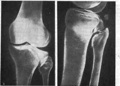 Переломи виростків великогомілкової кістки: терміни лікування і реабілітація, Імпресійна і внутрішньосуглобової перелом | Ревматолог