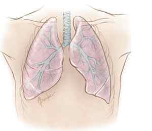 Пересадка легенів (трансплантація): показання, хід, прогноз