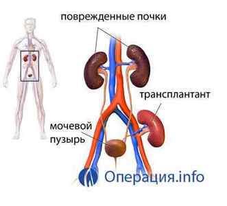 Пересадка нирки (трансплантація): операція, де і як роблять