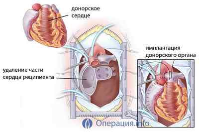 Пересадка серця (трансплантація): операція і її результат