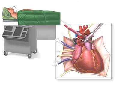 Пересадка серця (трансплантація): операція і її результат