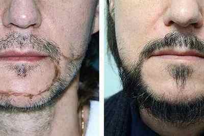 Пересадка волосся на бороду: операція, ціна, відгуки та фото по темі