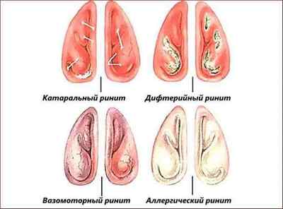 Перевірені народні засоби від болю в горлі