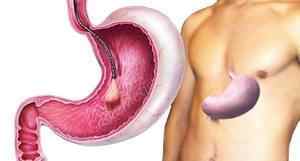 Перевірити шлунок без ковтання зонда: методи дослідження органу, їх ціна