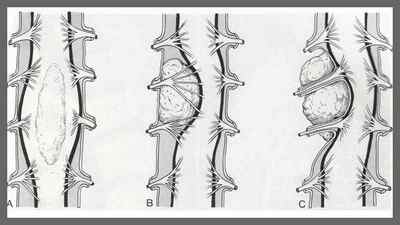 Періневральная кіста хребта: що це таке, кіста Тарлова на рівні s2 хребця, лікування народними засобами | Ревматолог