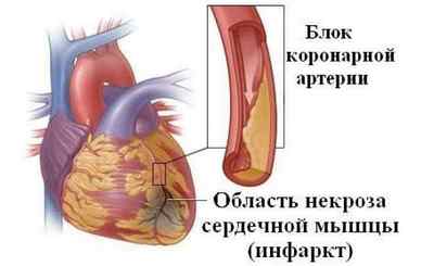 Перші ознаки і симптоми інфаркту міокарда