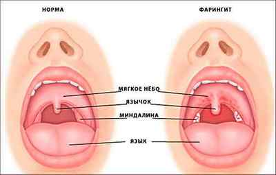 Першіння в горлі і сухий кашель: лікування народними засобами